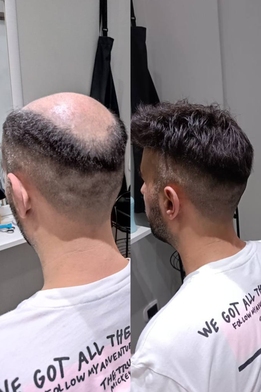 Installazione Patch Capillari